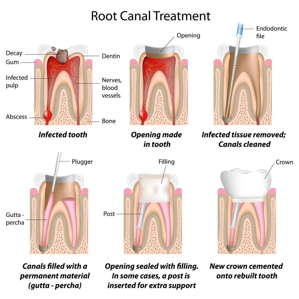 Root Canal Endodontics Tooth Pain Relief Mountain View Palo Alto Ca